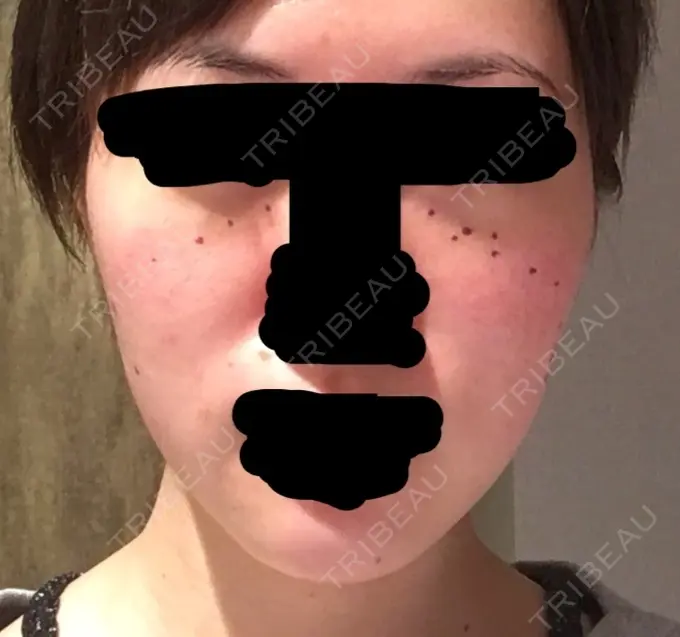 その他（肌） / 再生医療 / PRP皮膚再生療法 聖心美容クリニック 六本木院 BEFORE メイン用