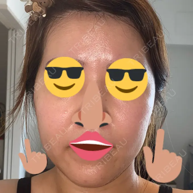 その他（肌） / エレクトロポレーション / RF（高周波）たるみ治療 / ポテンツァ ゆきスキンクリニック 東池袋 BEFORE メイン用