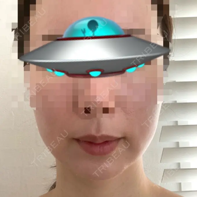 糸リフト / 骨切り（あご） / 脂肪吸引注射（顔） 銀座マイアミ美容外科 BEFORE メイン用