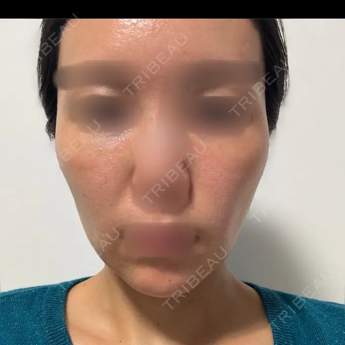 ピーリング（ニキビ・毛穴） / LED治療 東京素肌クリニック 銀座本院 BEFORE メイン用