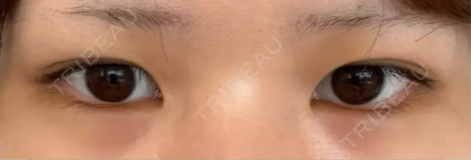 二重埋没 / 上まぶたの脂肪取り THE FIRST CLINIC 多摩センター院 BEFORE メイン用