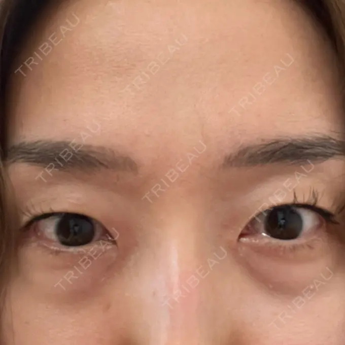 クマ治療 セオリークリニック BEFORE メイン用