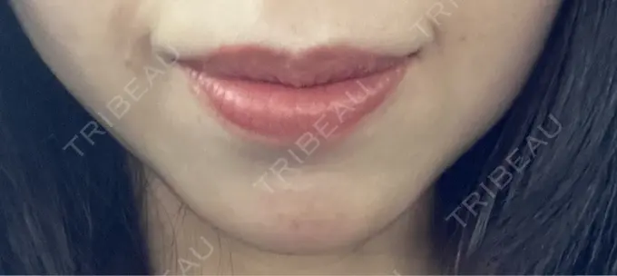 ボトックス（あご） ルラ美容クリニック 名古屋本院 BEFORE メイン用