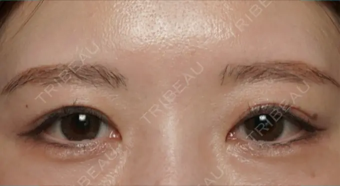 二重埋没 / 目頭切開 / クマ治療 ROOTS Clinic BEFORE メイン用