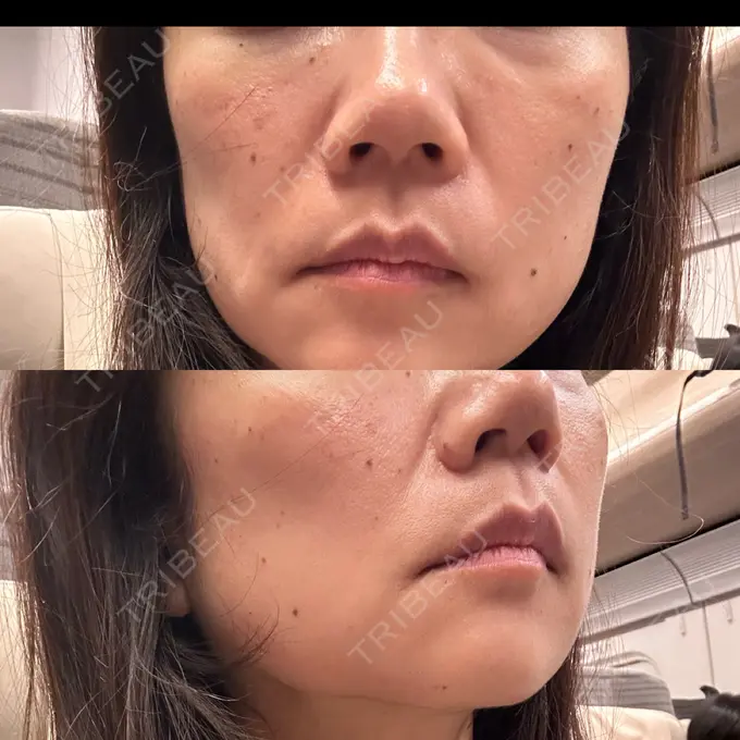 ボトックス（口角） / ルメッカ ルラ美容クリニック 渋谷本院 BEFORE メイン用