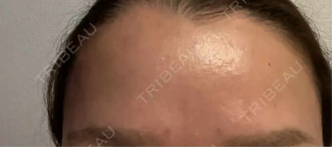 ボトックス（額） TCB東京中央美容外科 横浜駅前院 BEFORE メイン用