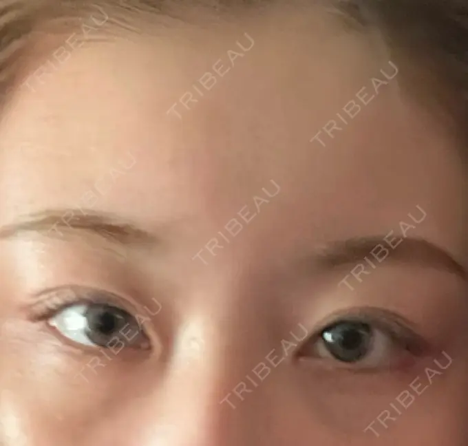 クマ治療 ROOTS Clinic BEFORE メイン用