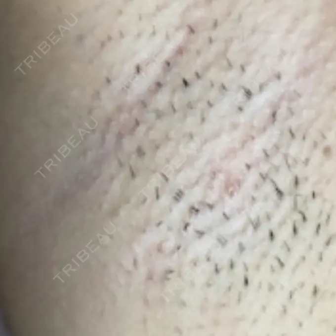 医療脱毛（ワキ） 湘南美容クリニック 自由が丘院 BEFORE メイン用