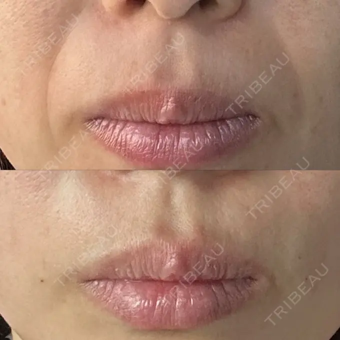 糸リフト / クマ治療 / ボトックス（あご） / 肌ヒアルロン酸注入（たるみ・シワ改善） / ボトックス（口角） / 脂肪溶解注射（二の腕） / ボトックス（肩） / ボトックス（眉間） / ボトックス（額） TCB東京中央美容外科 岐阜院 BEFORE メイン用