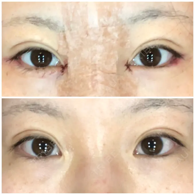 目頭切開 / バッカルファット除去 / 目尻切開 / 眉間プロテーゼ 湘南美容クリニック 大宮院 BEFORE メイン用