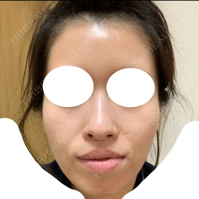 鼻尖形成（切開） / 鼻中隔延長（切開） / 軟骨移植 / 鼻尖縮小 エートップ美容整形外科 BEFORE メイン用