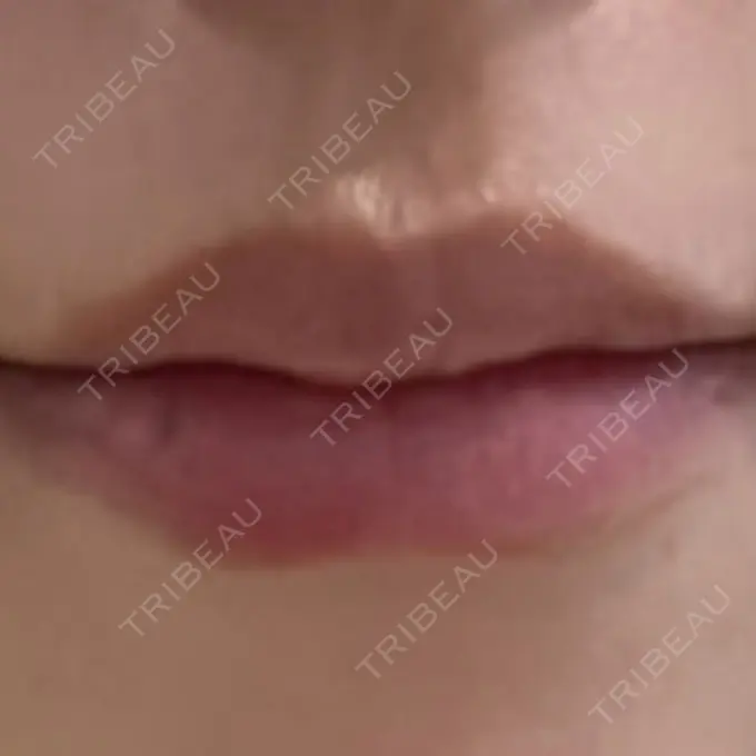 ヒアルロン酸注入（涙袋） / ヒアルロン酸注入（唇） / ヒアルロン酸注入（鼻翼基部） HAAB BEAUTY CLINIC 名古屋院 BEFORE メイン用