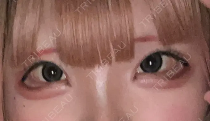 ヒアルロン酸注入（涙袋） / ボトックス（エラ・小顔） TCB東京中央美容外科 熊本院 BEFORE メイン用