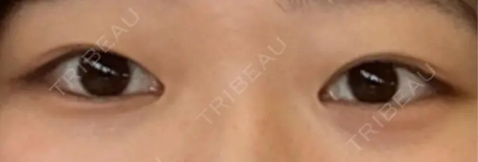 二重埋没 / 上まぶたの脂肪取り アリエル美容クリニック 郡山院 BEFORE メイン用
