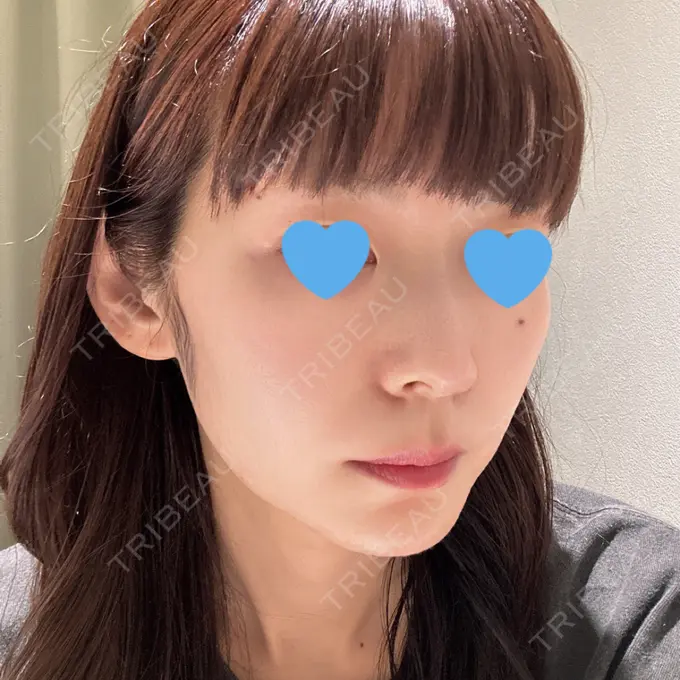 クマ治療 TCB東京中央美容外科 柏院 BEFORE メイン用