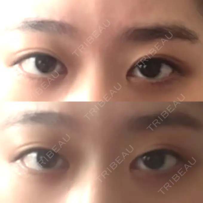 二重埋没 / ボトックス（エラ・小顔） 湘南美容クリニック 二子玉川院 BEFORE メイン用