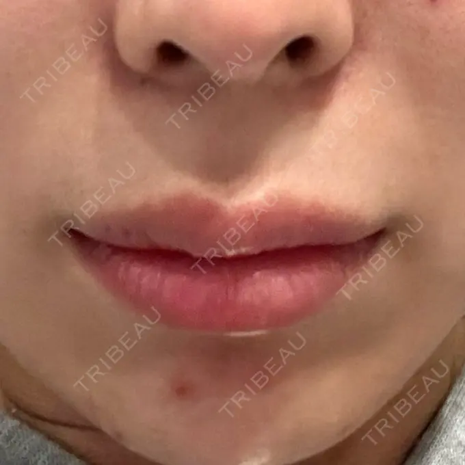 人中短縮 / 目尻切開 / ヒアルロン酸注入（鼻翼基部） 新宿ラクル美容外科クリニック 六本木院 BEFORE メイン用