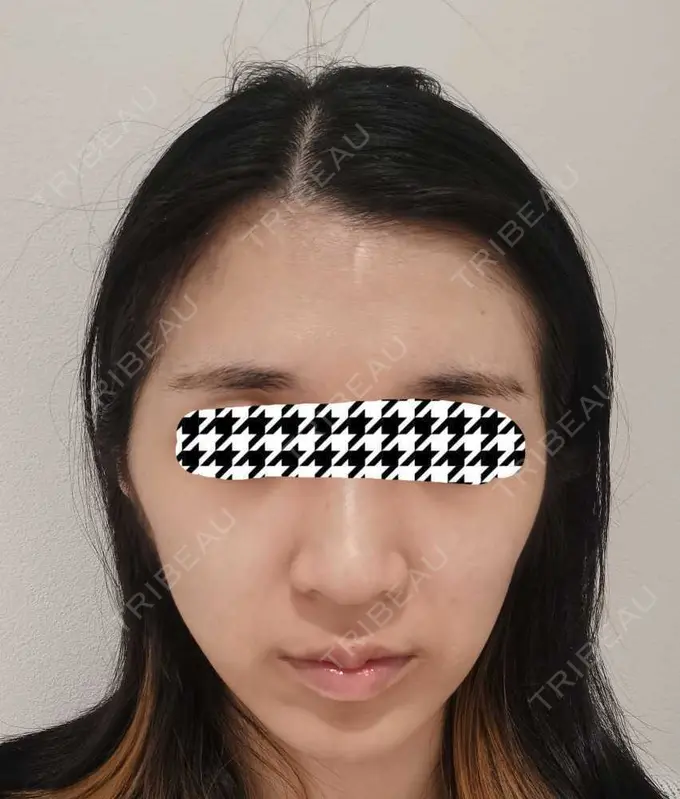 ルメッカ ルラ美容クリニック 高田馬場院 BEFORE メイン用