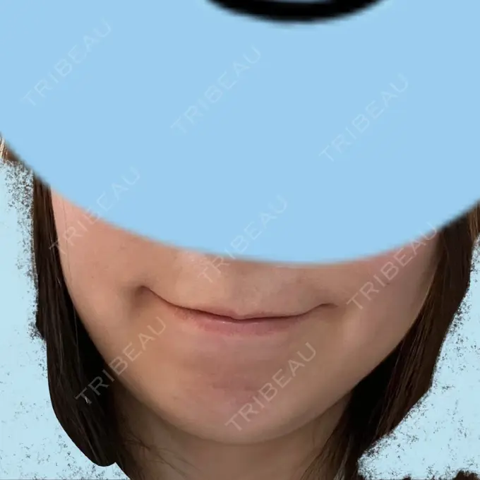 脂肪溶解注射（顔） 表参道ウィズ・クリニック BEFORE メイン用