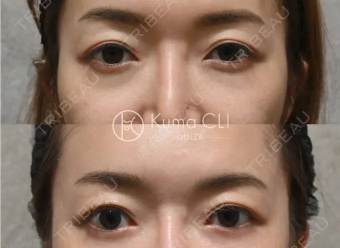 クマ治療 Kuma CLI 【クマクリ】 BEFORE メイン用