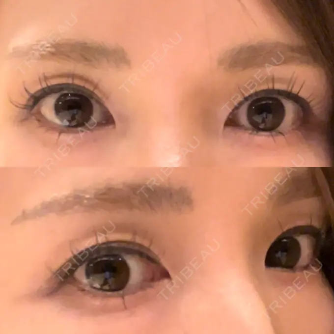 二重埋没 吉祥寺アイビークリニック BEFORE メイン用