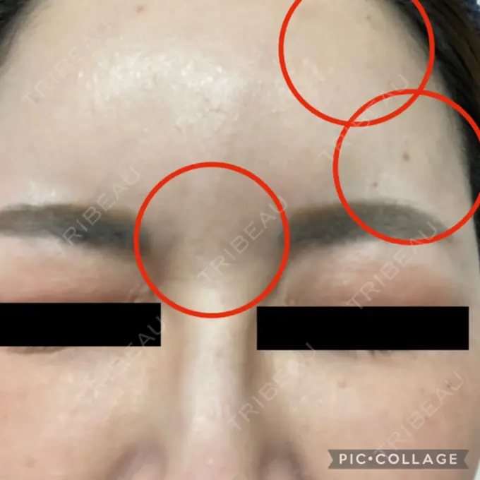 ボトックス（口角） / ボトックス（眉間） / ボトックス（目尻） / ボトックス（額） / その他（鼻） M'sクリニック【エムズクリニック】 BEFORE メイン用