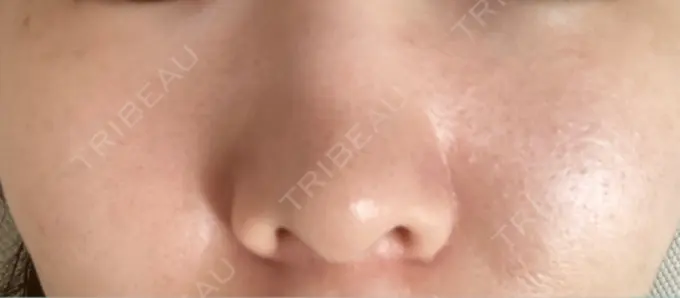 ピーリング（ニキビ・毛穴） / エレクトロポレーション / レーザートーニング（美白・肝斑） 湘南美容クリニック 川崎院 BEFORE メイン用