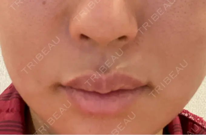 人中短縮 / 口唇縮小術 / 口角挙上 新宿ラクル美容外科クリニック 新宿院 BEFORE メイン用