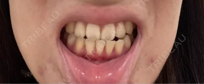 ホワイトニング 池袋駅前デンタルクリニック BEFORE メイン用