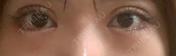 ヒアルロン酸注入（涙袋） リエンジャン整形外科 江南店 BEFORE メイン用