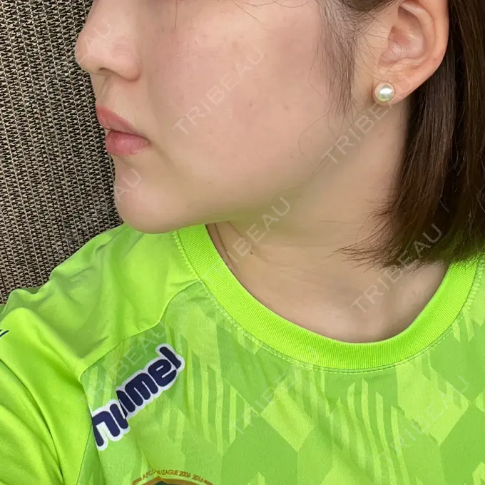 ヒアルロン酸注入（あご） / ボトックス（エラ・小顔） / 脂肪溶解注射（顔） TCB東京中央美容外科 京都四条院 BEFORE メイン用