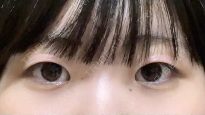 二重埋没 / 目頭切開 東京シンデレラ美容外科 池袋院 BEFORE メイン用