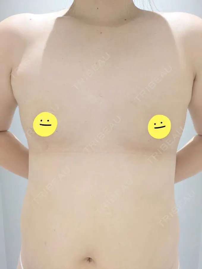 脂肪吸引（脚） / 脂肪吸引（お尻） / 豊胸（脂肪注入） Mods Clinic（モッズクリニック） 名古屋院 BEFORE メイン用