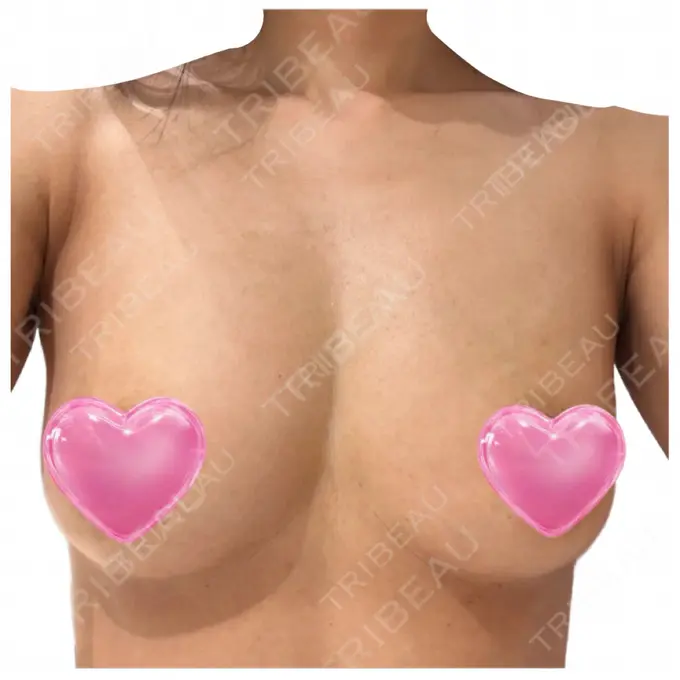 脂肪吸引（二の腕） / 豊胸（脂肪注入） / 脂肪吸引（腰） / 脂肪吸引（肩） Mods Clinic（モッズクリニック） 名古屋院 BEFORE メイン用