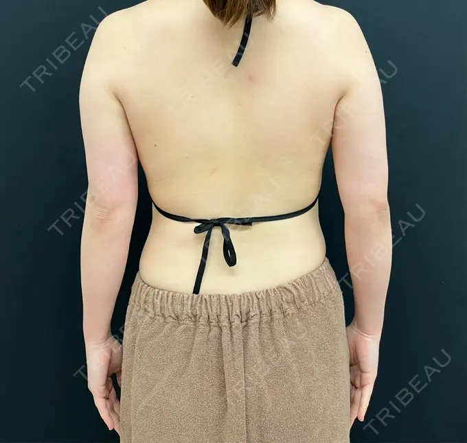 糸リフト / バッカルファット除去 / 脂肪吸引（顔） / 脂肪吸引（二の腕） 湘南美容クリニック 京都院 BEFORE メイン用