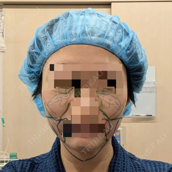 糸リフト / クマ治療 / 脂肪吸引（顔） / 脂肪注入（目の下） 東京ココセランクリニック BEFORE メイン用