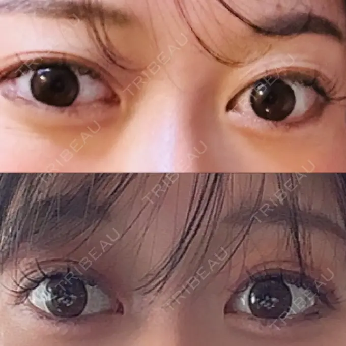 二重埋没 水の森美容クリニック 大阪梅田院 BEFORE メイン用