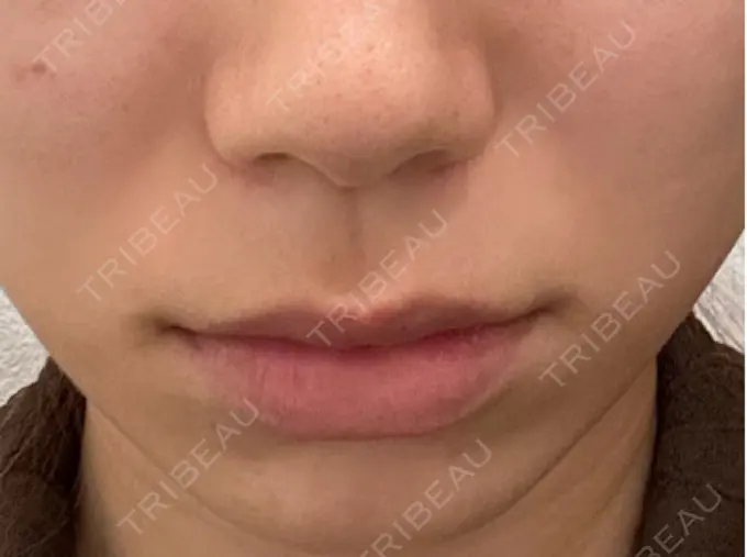 人中短縮 もとび美容外科クリニック 新宿院 BEFORE メイン用