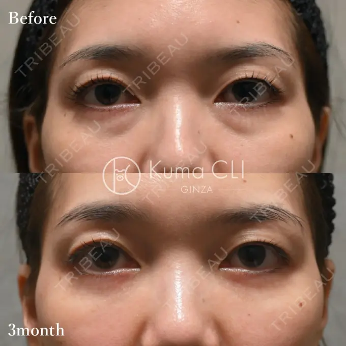 クマ治療 Kuma CLI 【クマクリ】 BEFORE メイン用