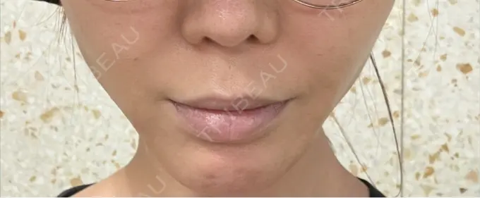 人中短縮 / 口角挙上 Otus Clinic 【オータスクリニック】 BEFORE メイン用