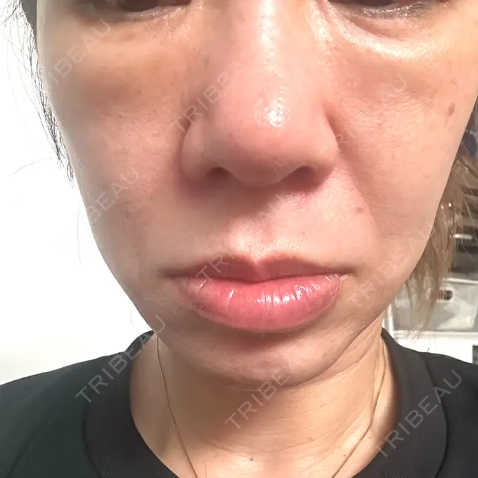 肌ヒアルロン酸注入（たるみ・シワ改善） / ピコレーザートーニング（美白・肝斑） ルラ美容クリニック 仙台院 / ルラスキンクリニック 仙台院 BEFORE メイン用