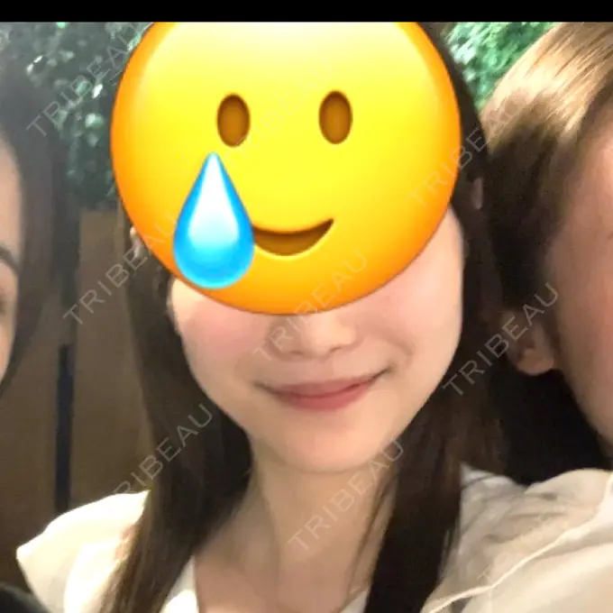 糸リフト / 脂肪吸引（顔） / ジョールファット除去 RIVER CLINIC（リバークリニック） BEFORE メイン用