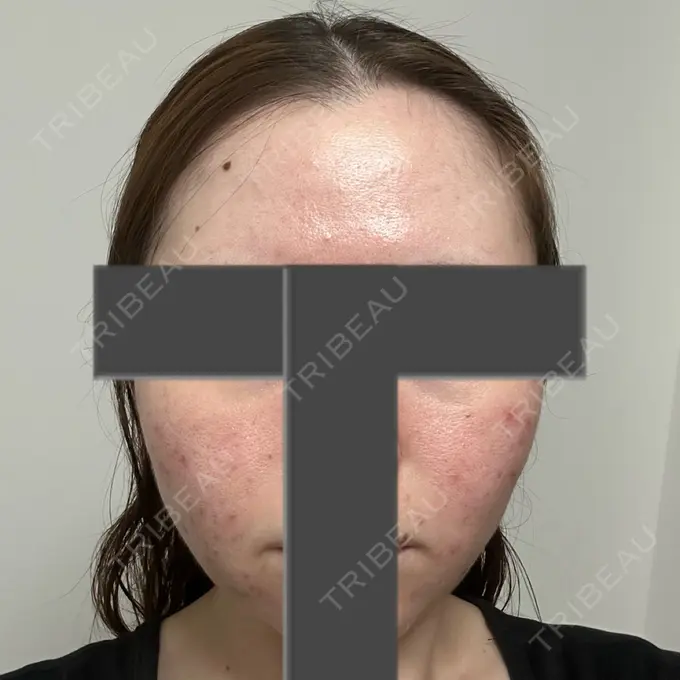 ニードルRF（ポテンツァなど） 東京美容外科 池袋院 BEFORE メイン用