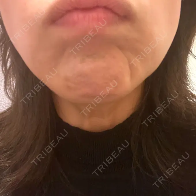 ボトックス（エラ・小顔） / ボトックス（眉間） / ボトックス（目尻） 湘南美容クリニック 名古屋栄院 BEFORE メイン用