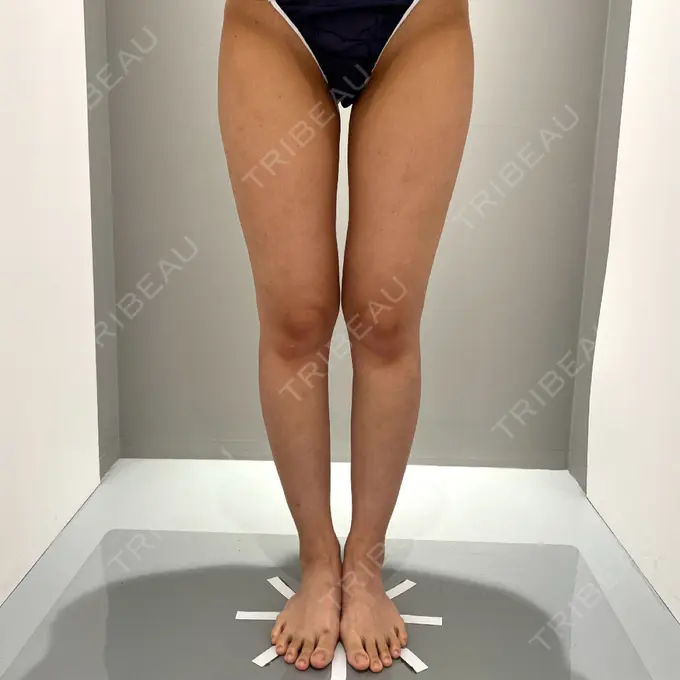 脂肪吸引（脚） Mods Clinic（モッズクリニック） 名古屋院 BEFORE メイン用