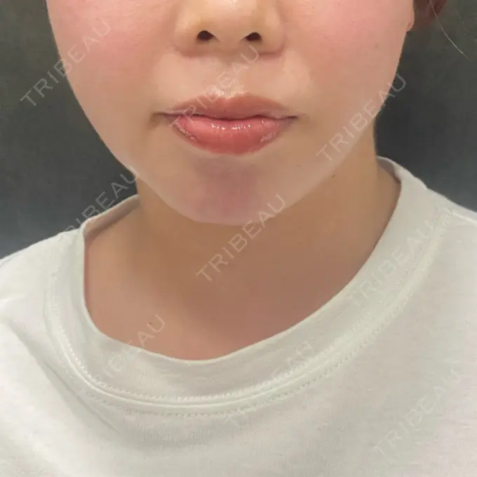 インディバ（顔） WOM SALON【術後ケア取扱いサロン】 BEFORE メイン用