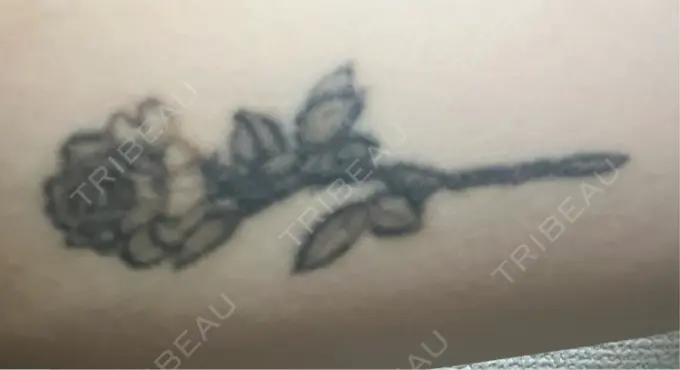 タトゥー除去 ルラ美容クリニック 福岡本院 BEFORE メイン用