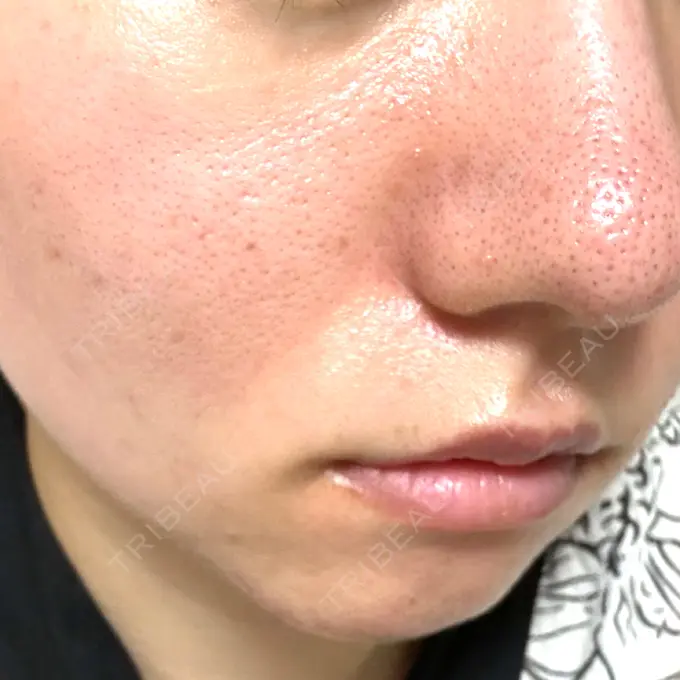 フラクショナルレーザー（毛穴・ニキビ跡） しらゆりメディカルクリニック （旧しらゆりビューティークリニック） BEFORE メイン用