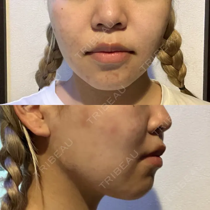 糸リフト 東京シンデレラ美容外科 池袋院 BEFORE メイン用