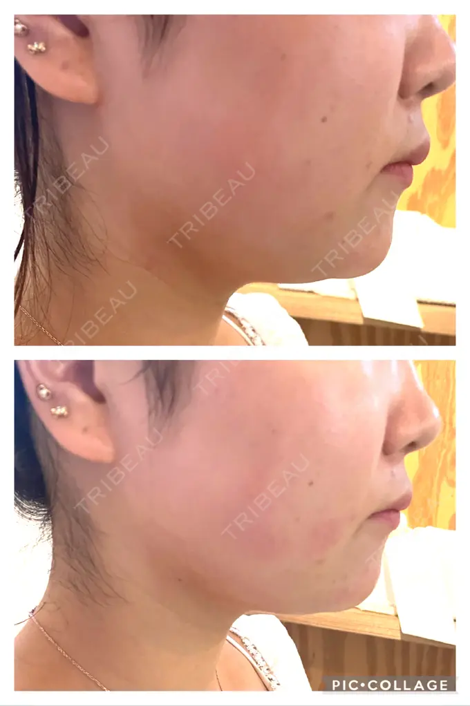 脂肪溶解注射（顔） 麻布十番クレールデンタルクリニック BEFORE メイン用